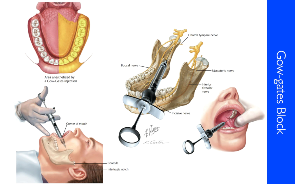 Anesthesia in dentistry